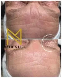Matrix Lift