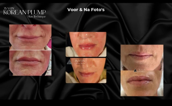 Korean Plump voor Lippen